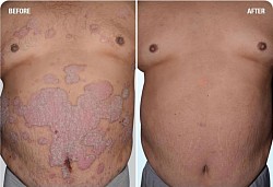 PSORIASIS BEFORE & AFTER