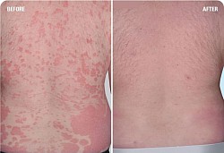 PSORIASIS BEFORE & AFTER