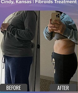 FIBROID BEFORE AND AFTER