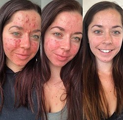 FUNGI ACNE TREATMENT