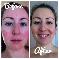 LUPUS BEFORE AND AFTER