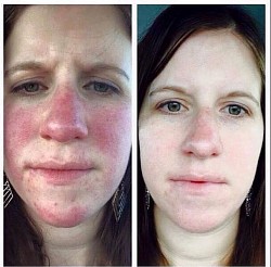 LUPUS BEFORE AND AFTER