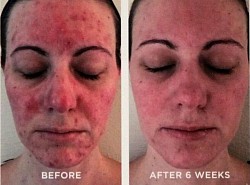 LUPUS BEFORE AND AFTER